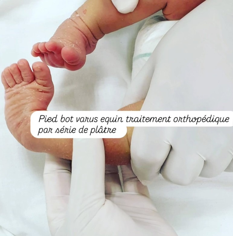Traitement orthopédique d'un pied bot varus équin par série de plâtres chez un nouveau-né